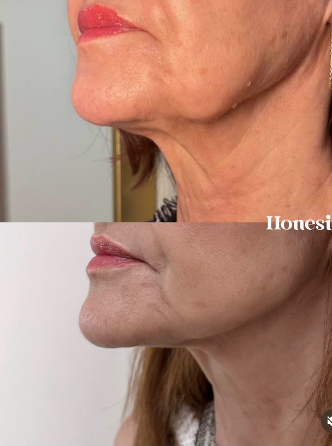 Antes y después: Perfil mandibular
