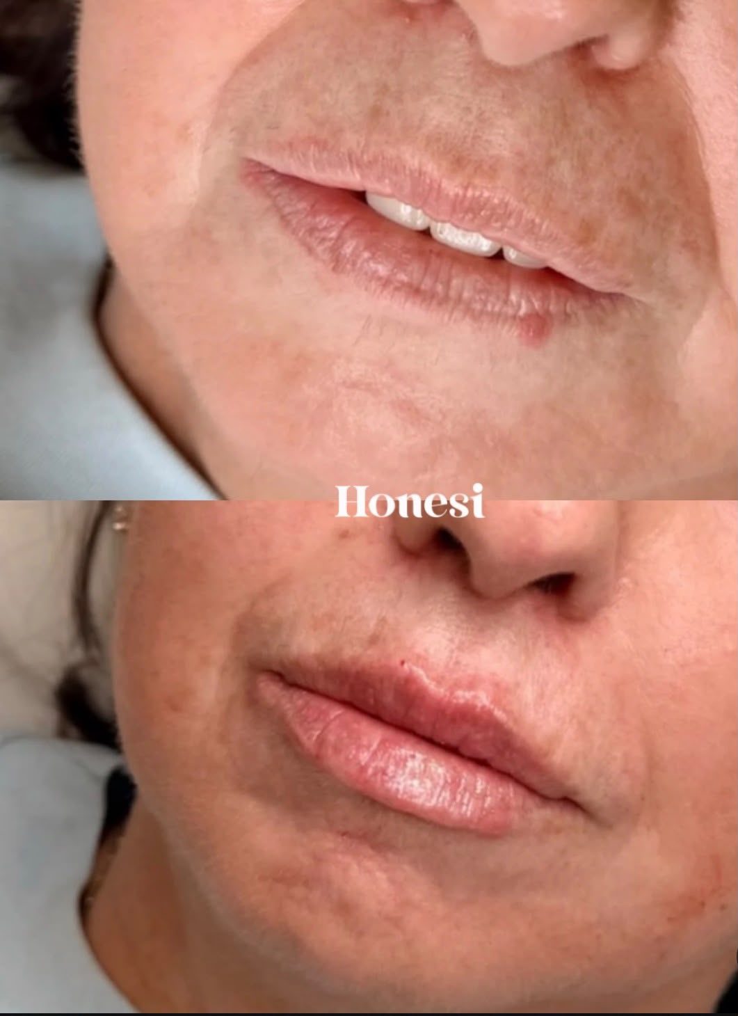 Antes y después: Aumento de labios