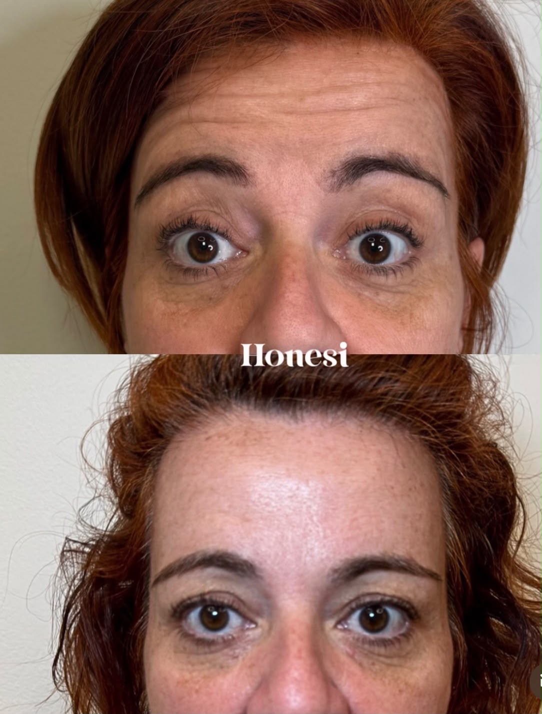 Antes y después: Neuromoduladores