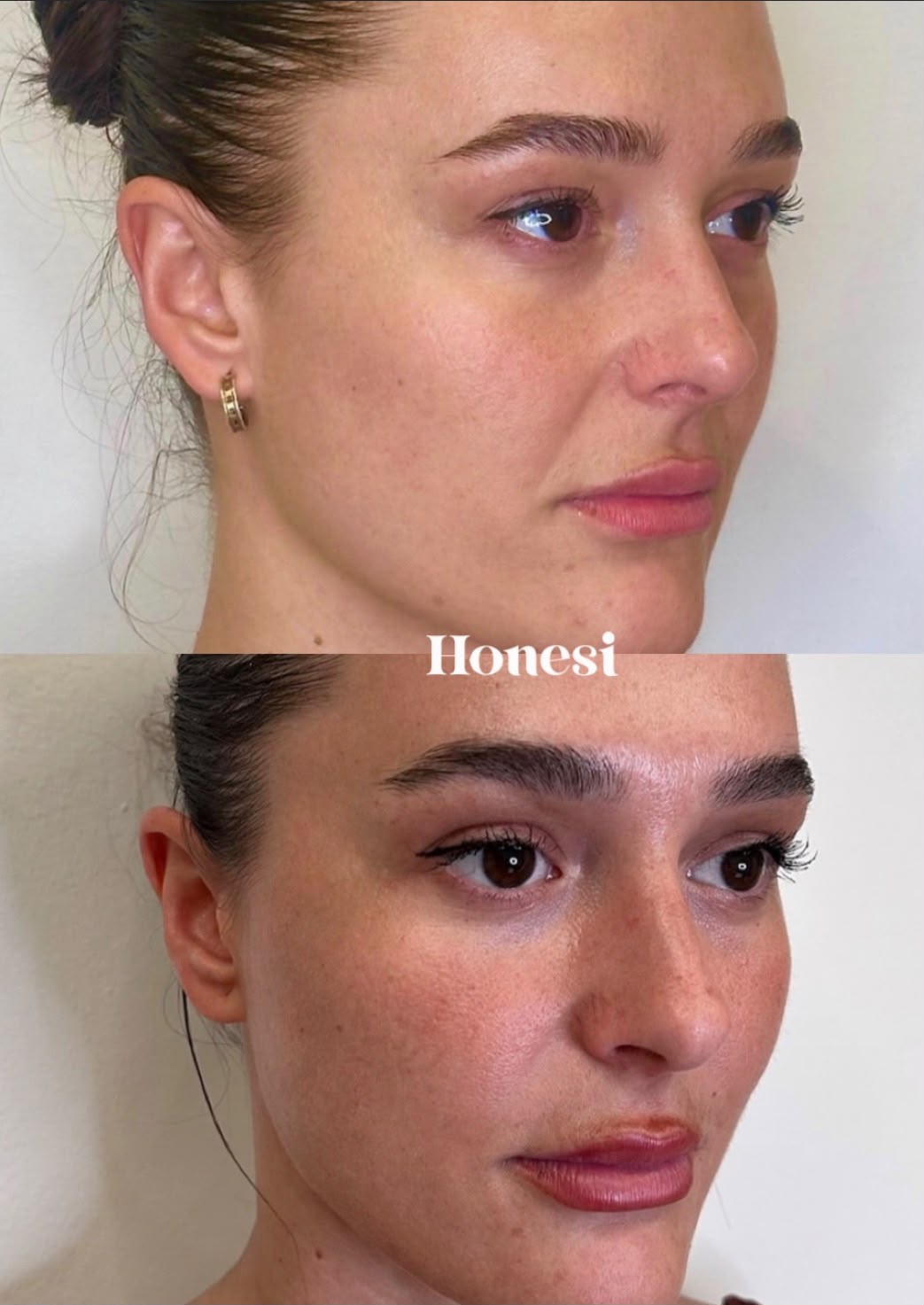 Antes y después: Pómulos